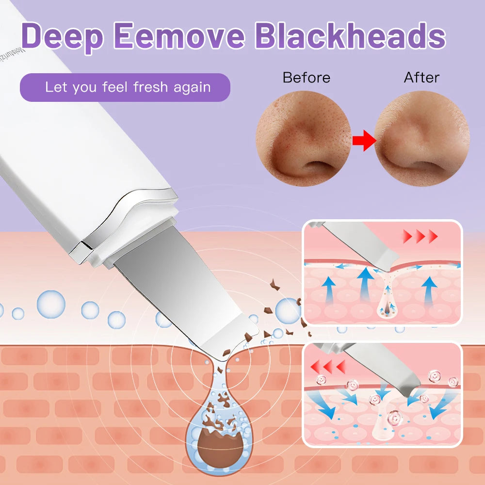 Electric Ultrasonic Skin Scrubber – Facial Cleansing & Blackhead Remover Spatula